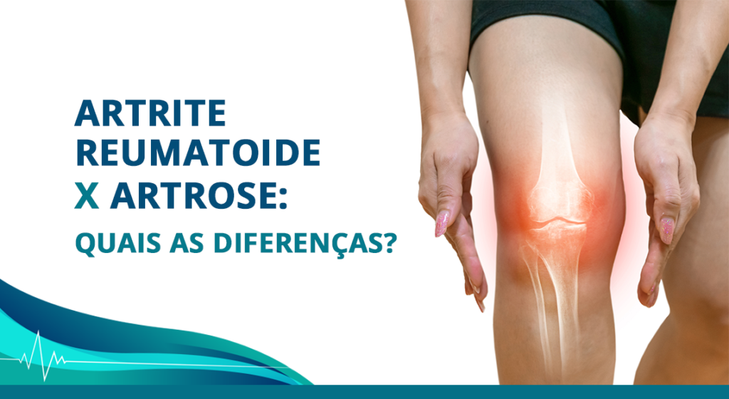 Dr Paulo Casali - Artrite Reumatoide x Artrose, Quais as Diferenças