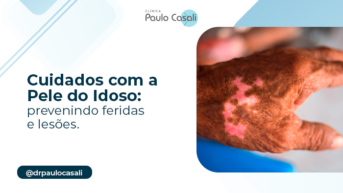 Mão idosa com manchas claras na pele, destacando a importância dos cuidados para prevenir feridas e lesões na pele envelhecida.